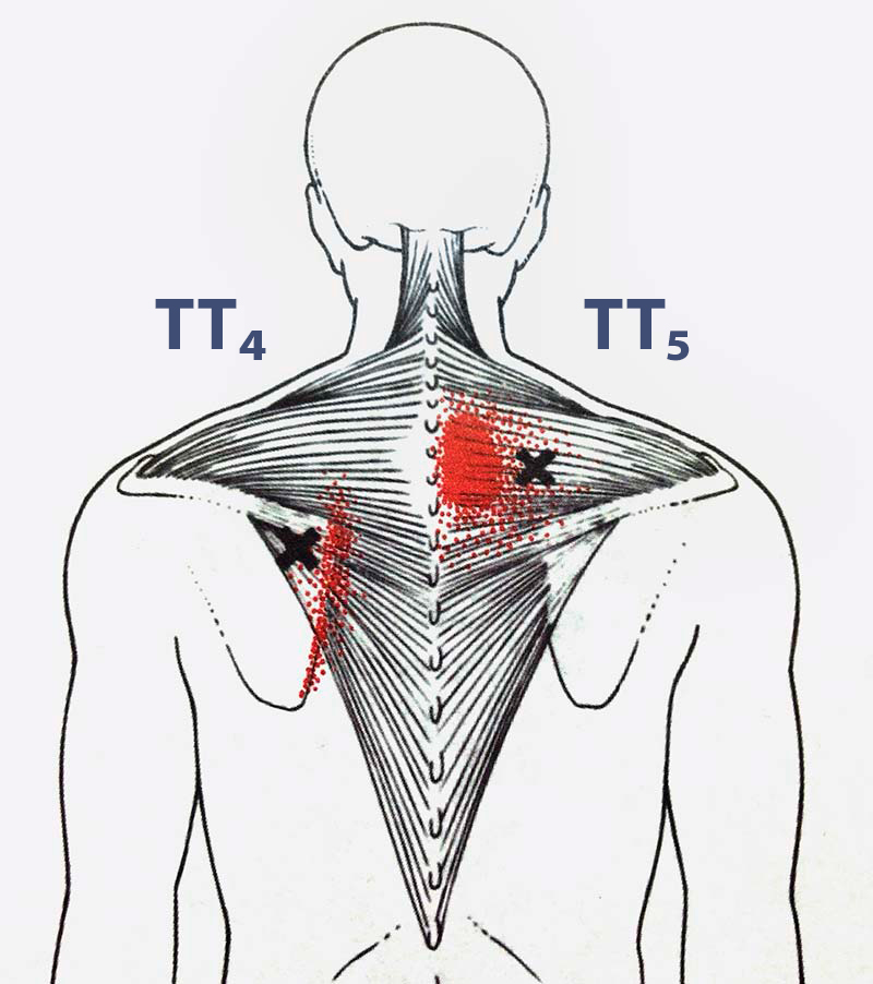 Болит мышца спины справа. Триггерные точки ромбовидной мышцы. Ромбовидная мышца спины триггерные точки. Ременная мышца триггерные точки. Триггерные точки в мышцах спины.
