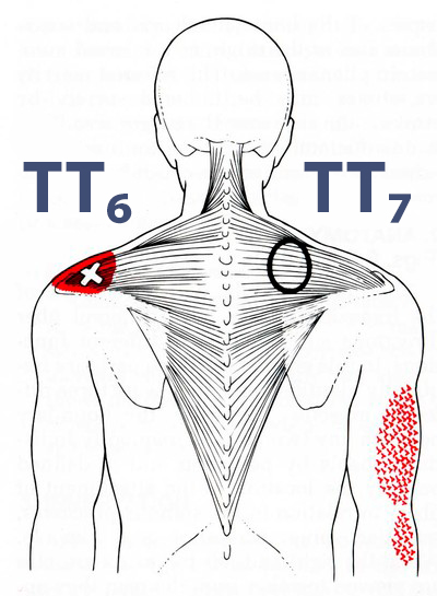 Трапециевидная мышца спины триггерные точки. Триггерные точки на спине схема и зона отраженной. Трапециевидная мышца отраженная боль. Трапециевидная мышца спины болит.